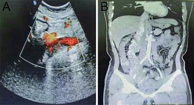 Case Report: A case of uterine leiomyosarcoma metastasized to the vena cava, excised with the aid of preoperative CT three-dimensional imaging